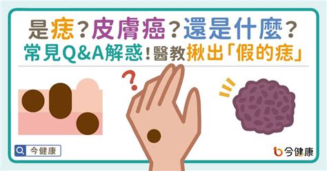 右下巴痣長毛|是痣or皮膚癌？醫「1張圖秒對照」 長這2部位最危險